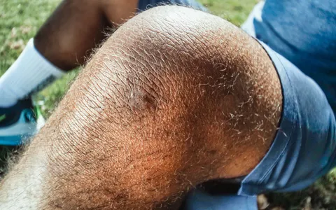 Corredor com a mão sobre o joelho após sentir dor durante o treino ao ar livre